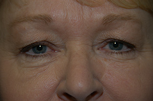 Blepharoplasty 2a
